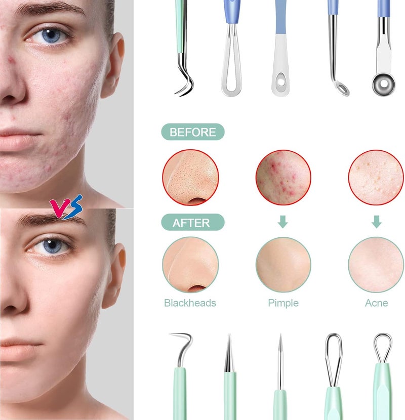 MENOLY Blackhead Remover Tools 10Pcs Pimple Popper Tool Kit, Blackhead Remover Extractor Tools, Pimple Comedone Extractor Acne Kit for Blackhead,Blemish,Zit Whitehead with Leather Bag - Image 3
